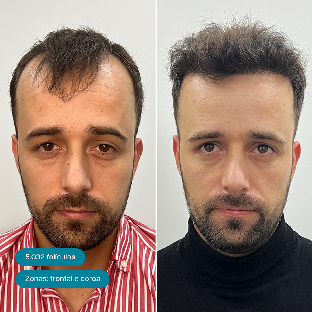 Antes e Depois 9