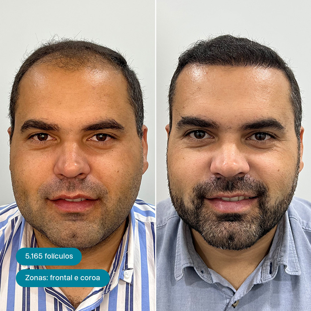 Antes e Depois 10
