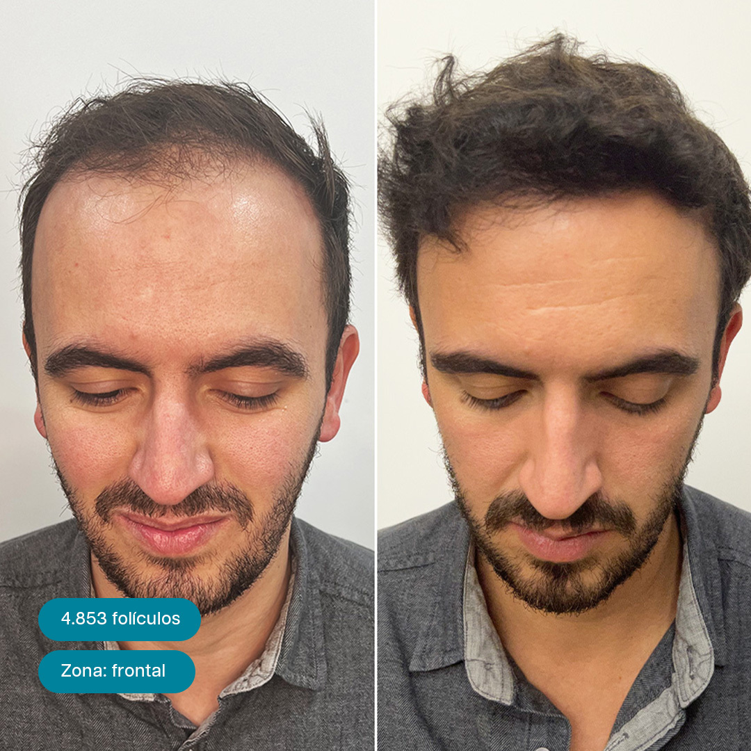 Antes e Depois 7