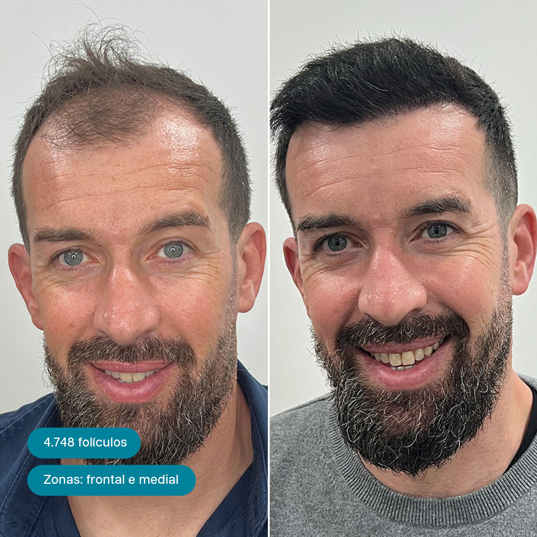 Antes e Depois 6