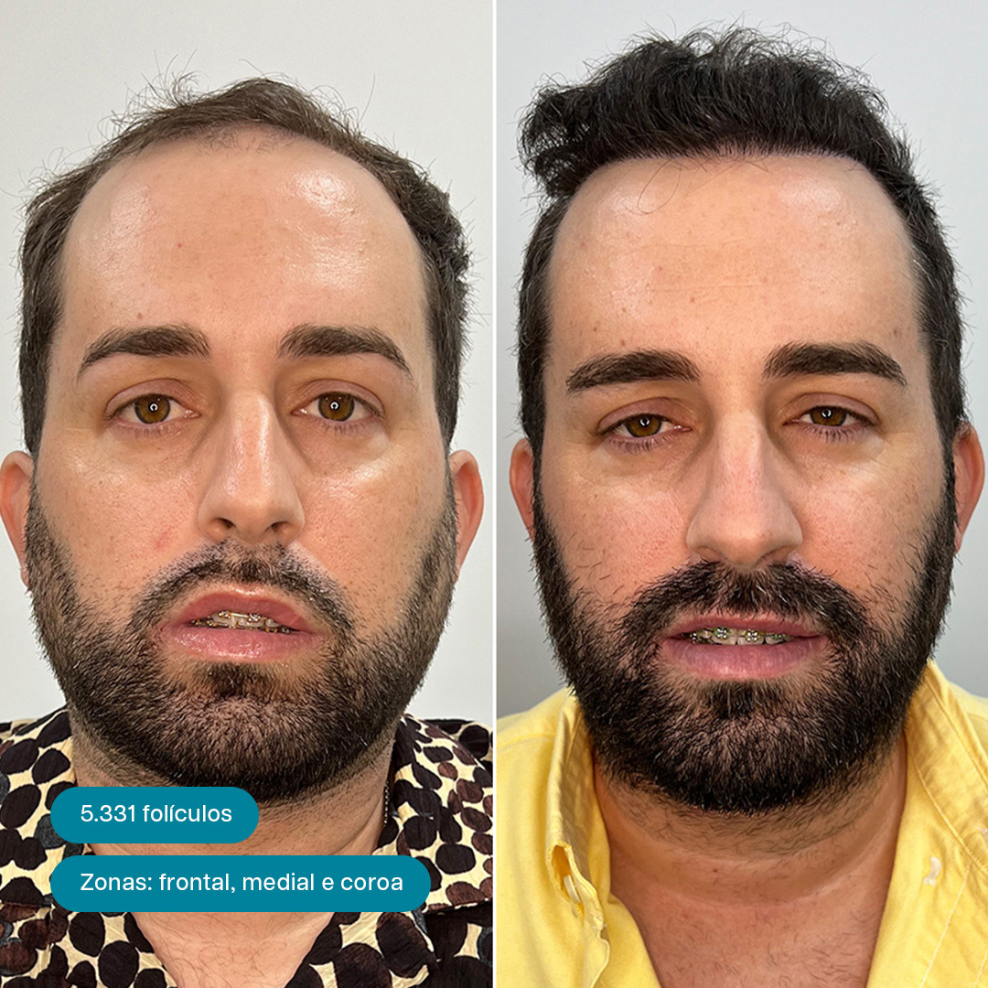 Antes e Depois 5