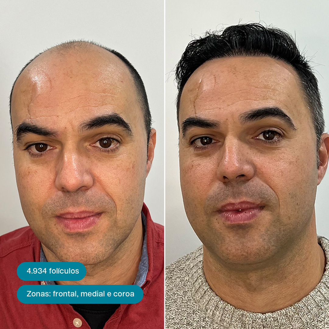 Antes e Depois 4