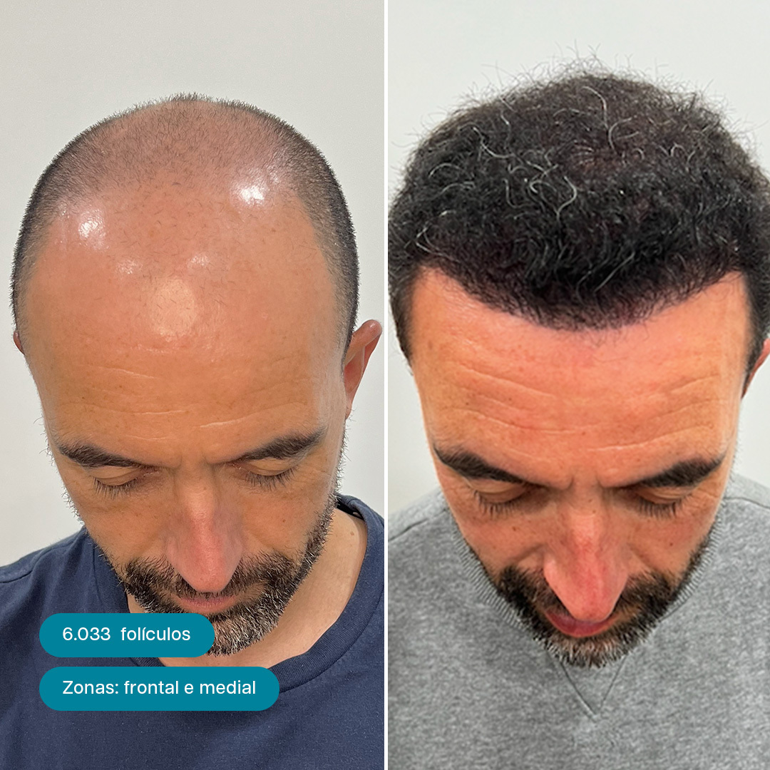 Antes e Depois 2