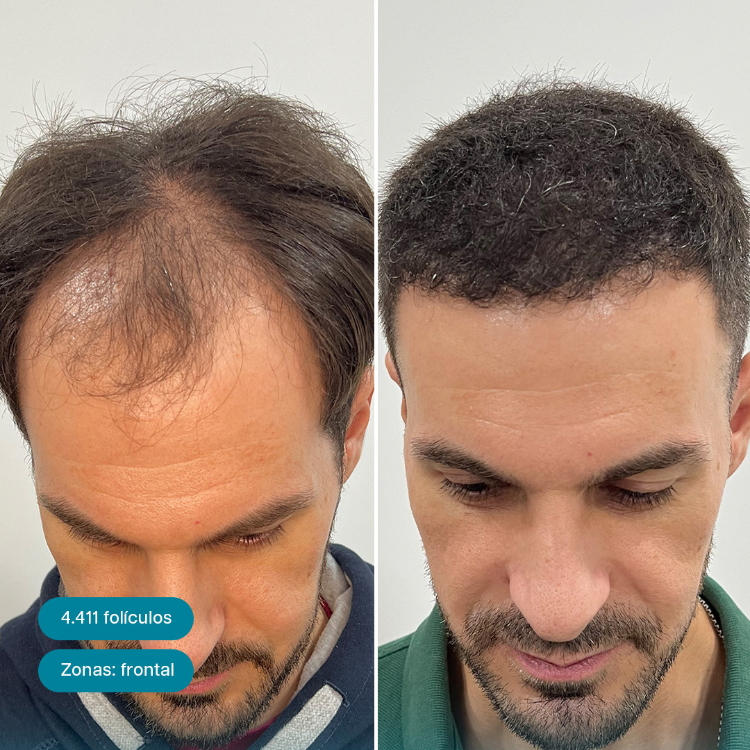 Antes e Depois 16