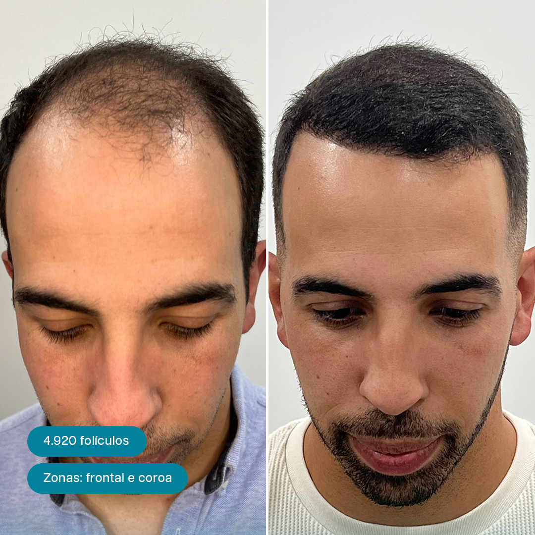 Antes e Depois 12