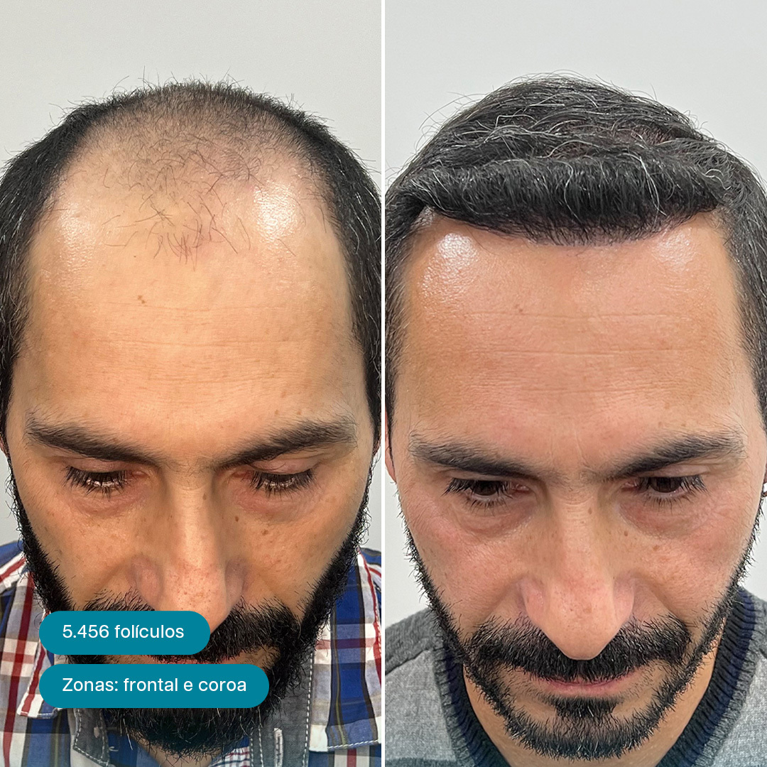 Antes e Depois 13