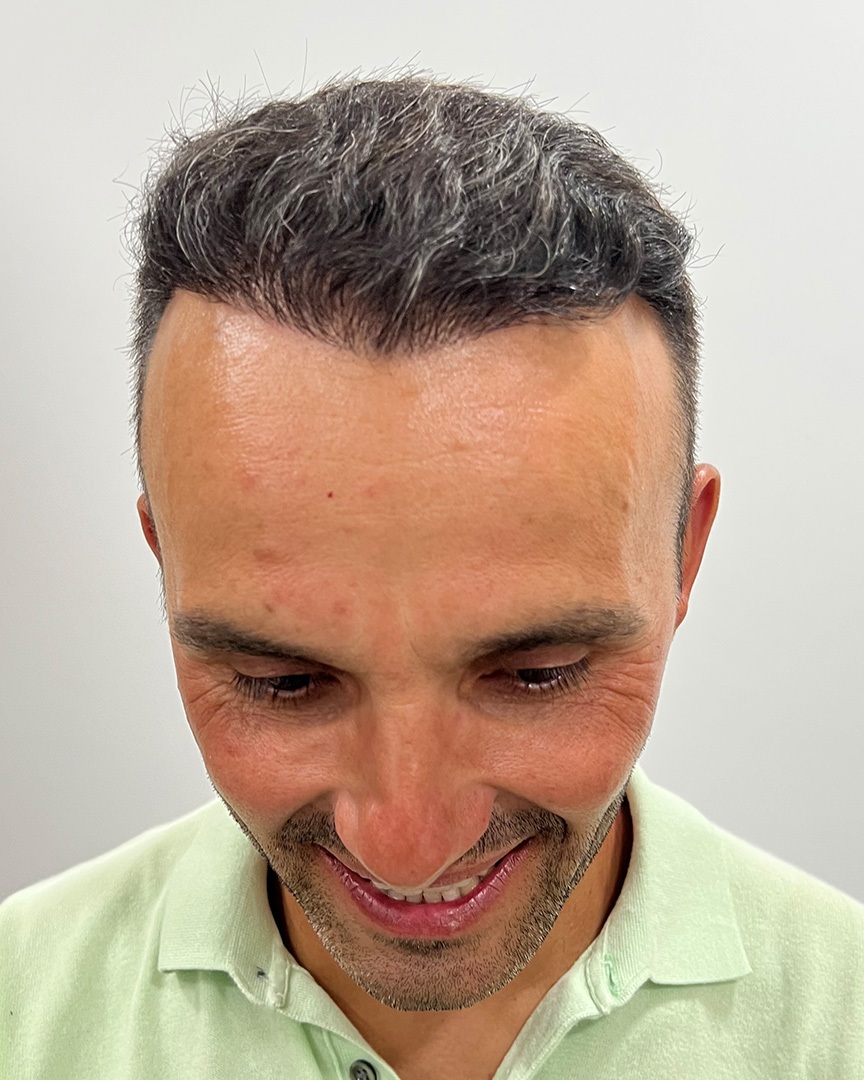 Pedro Fernandes Depois